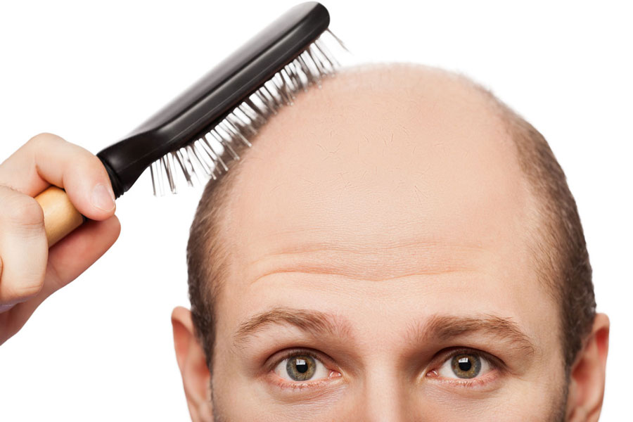 ریزش مو hair-loss