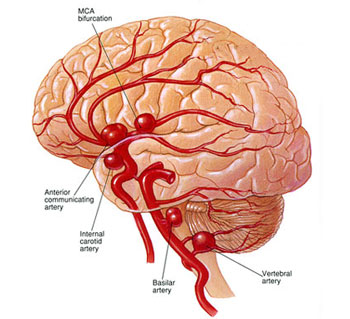 علائم آنوریسم مغزی|عوارض آنوریسم مغزی